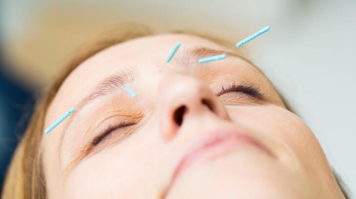 acupuncture for facelift singapore